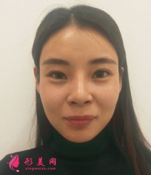 南京美貝爾整形醫(yī)院自體脂肪面填案例