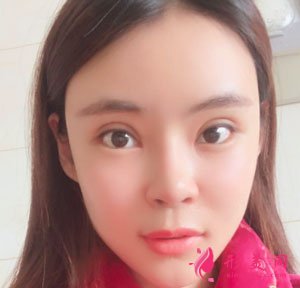 南京美貝爾整形醫(yī)院自體脂肪面填案例