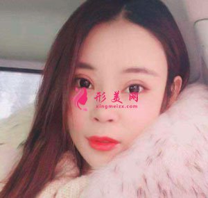 南京美貝爾整形醫(yī)院自體脂肪面填案例