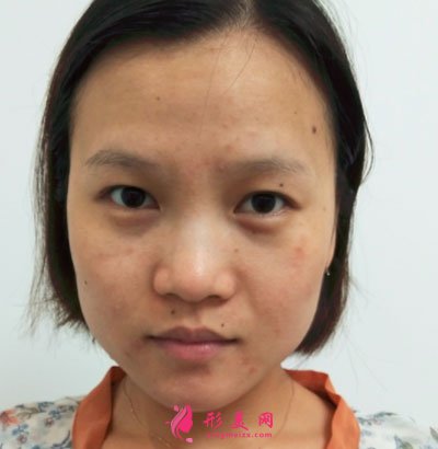 北京歐華醫(yī)療美容水光補水案例