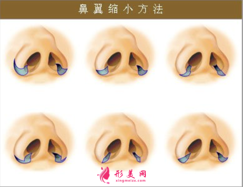鼻翼縮小整形的恢復(fù)時(shí)間