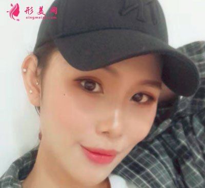 廈門華美醫(yī)療美容門診部除皺瘦臉的案例
