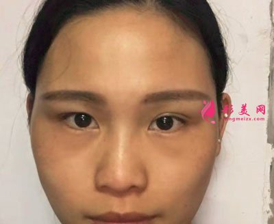 廈門華美醫(yī)療美容門診部除皺瘦臉的案例