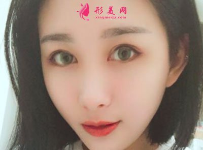 廈門華美醫(yī)療美容門診部眼部多項(xiàng)案例