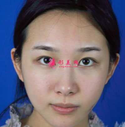 廈門華美醫(yī)療美容門診部眼部多項(xiàng)案例