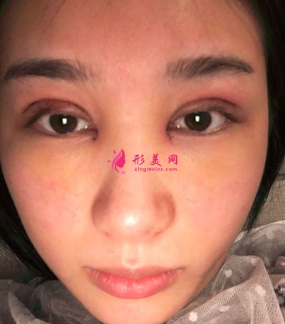 廈門華美醫(yī)療美容門診部眼部多項(xiàng)案例