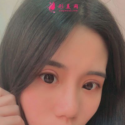 廈門華美醫(yī)療美容門診部眼部多項(xiàng)案例