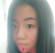 廈門華美醫(yī)療美容做的眼部多項怎么樣？真人案例對比圖分享