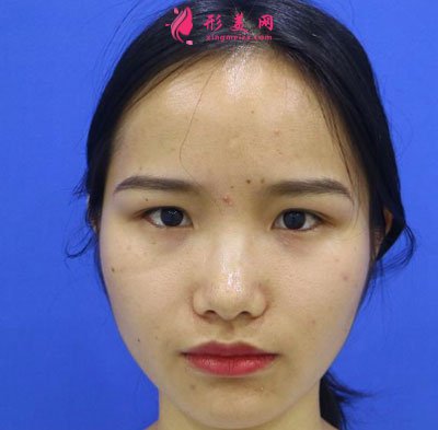 廈門安黛美醫(yī)療整形美容切開雙眼皮案例