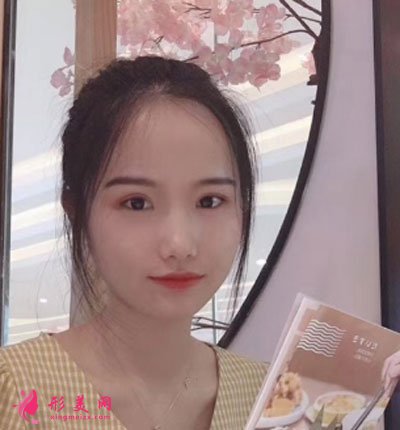 廈門安黛美醫(yī)療整形美容切開雙眼皮案例