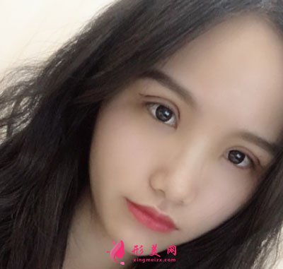 廈門安黛美醫(yī)療整形美容切開雙眼皮案例