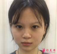 廈門安黛美醫(yī)療美容做雙眼皮怎么樣？真人案例分享