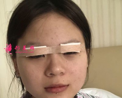 廈門安黛美醫(yī)療整形美容切開雙眼皮案例