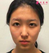 寧波靜港整形自體脂肪面部填充真人案例分享！術(shù)后兩個(gè)月效果很好