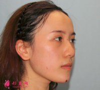 寧波薇琳醫(yī)療美容醫(yī)院肋軟骨隆鼻怎么樣？術(shù)后兩個(gè)月效果很滿意