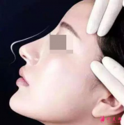 做了假體隆鼻側(cè)睡會(huì)移位嗎？