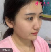 上海九院余東顴骨整形案例術后恢復日記，V臉來啦！