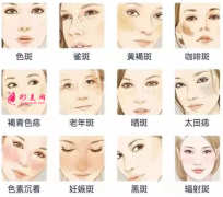 激光祛斑后會(huì)不會(huì)有結(jié)痂