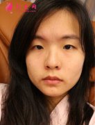 在上海美聯(lián)臣做的生物焊接雙眼皮，7天就能修煉成大眼鎂鋁！