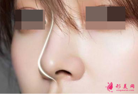 軟骨隆鼻費(fèi)用受什么因素影響
