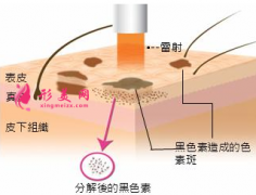 激光祛斑后多少天可以洗臉？