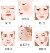 激光祛斑的費(fèi)用要多少錢？