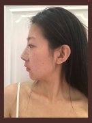 成都菲爾瑞楊樹楷做的鼻子整形，一個鼻子拯救整張臉!