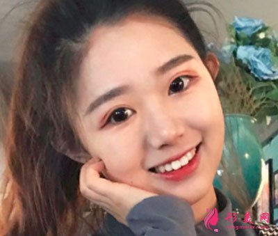 廈門華美于璇切開雙眼皮案例 廈門華美于璇切開雙眼皮案例