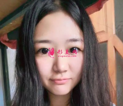 廈門華美于璇切開雙眼皮案例 廈門華美于璇切開雙眼皮案例