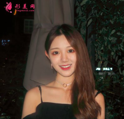 廈門華美于璇切開雙眼皮案例 廈門華美于璇切開雙眼皮案例