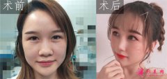 武漢韓辰醫(yī)療美容醫(yī)院吳輝鼻部整形案例對(duì)比圖_效果_價(jià)格分享