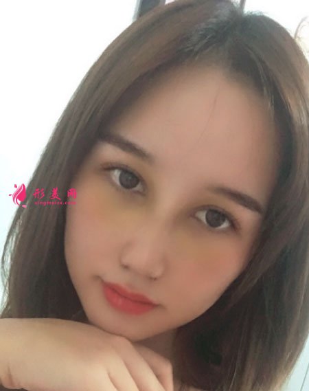 武漢韓辰醫(yī)療美容鼻部多項(xiàng)案例 