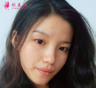 重慶美圣美邦醫(yī)療美容雙眼皮案例對比圖_效果_價格分享