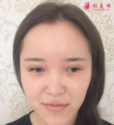 上海喜美王會勇鼻部修復(fù)怎么樣？案例_價格分享給你們