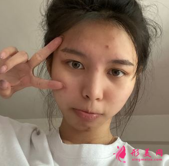 成都藝星周順波隆鼻效果怎么樣_假體硅膠隆鼻_真人案例