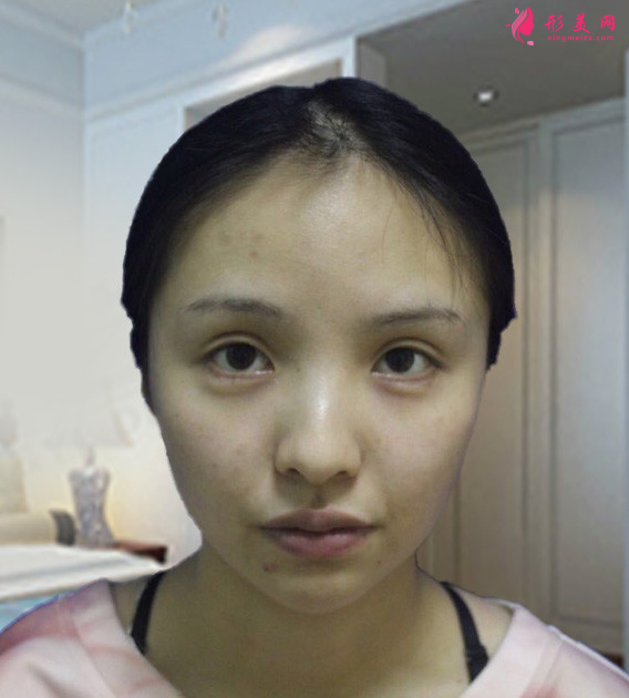 成都醫(yī)大整形醫(yī)院虞冬梅做鼻綜合怎么樣 成都醫(yī)大整形美容醫(yī)院的鼻綜合整形案例