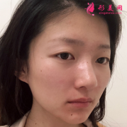 在四川(成都)美萊做的自體脂肪填充，三個(gè)月啦臉部圓潤(rùn)了不少