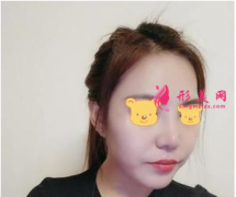 成都成美鄭敏做鼻子怎么樣？來(lái)看看我成美鄭敏給我做的鼻子吧