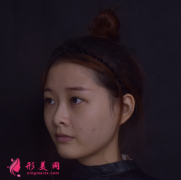 成都成美整形醫(yī)院王立鵬做的自體軟骨隆鼻,價格_案例分享