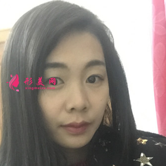 找成都銅雀臺雷剛做的三點式雙眼皮,案例_價格分享給大家
