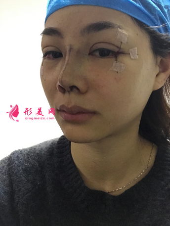 找成都銅雀臺雷剛做的三點式雙眼皮
