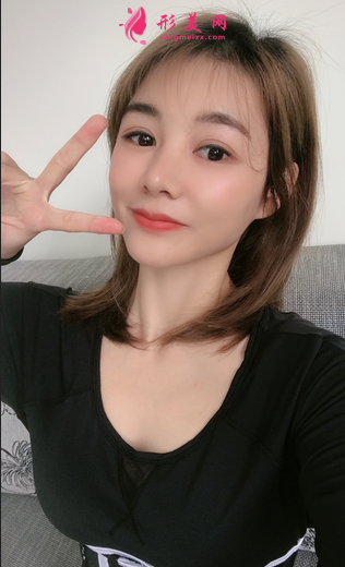 找成都銅雀臺雷剛做的三點式雙眼皮