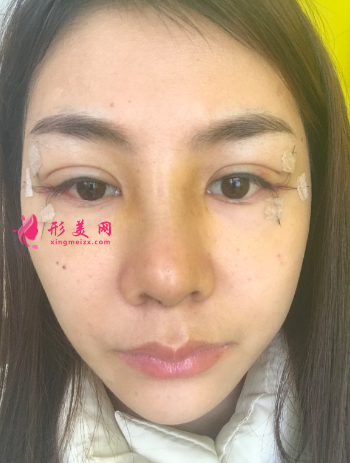 找成都銅雀臺雷剛做的三點式雙眼皮