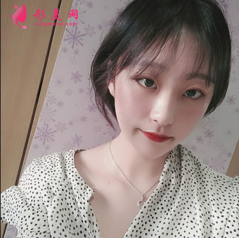 成都美萊做雙眼皮多少錢_埋線雙眼皮+外開(kāi)眼角怎么樣_案例效果