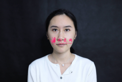成都美綻美楊平給我做的鼻綜合，案例價格分享