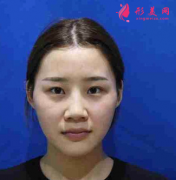 四川悅好醫(yī)學(xué)美容醫(yī)院雙眼皮怎么樣？給大家分享案例