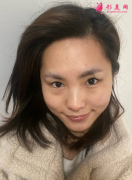 成都美綻美整形美容醫(yī)眼綜合好不好？案例分享給大家