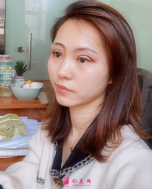 找成都美綻美整形美容醫(yī)院陳宇做的眼綜合，案例|價(jià)格分享給大家