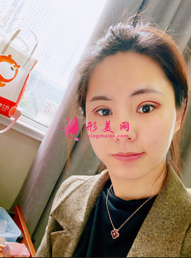 成都美綻美整形美容醫(yī)院陳宇做的眼綜合