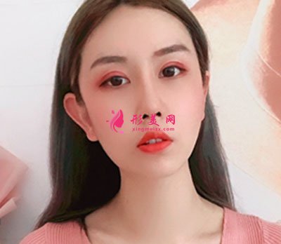 成都菲格隆鼻手術案例